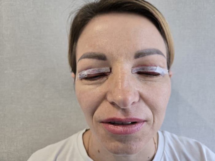 Блефаропластика